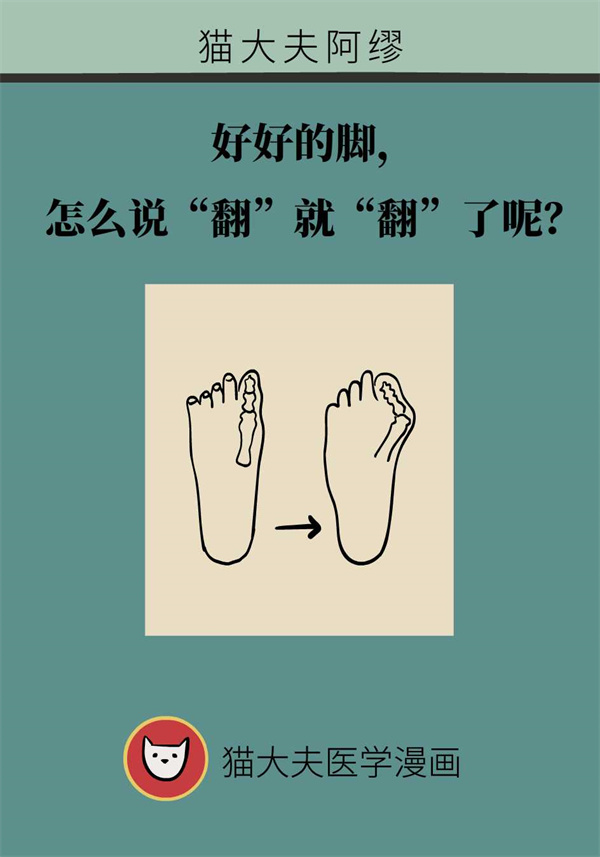 得了拇外翻怎么办？矫正方法看这里！